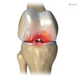 7 Tips Menjaga Kesehatan Sendi agar Terhindar dari Osteoarthritis