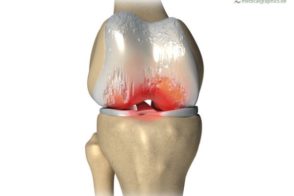 7 Tips Menjaga Kesehatan Sendi agar Terhindar dari Osteoarthritis