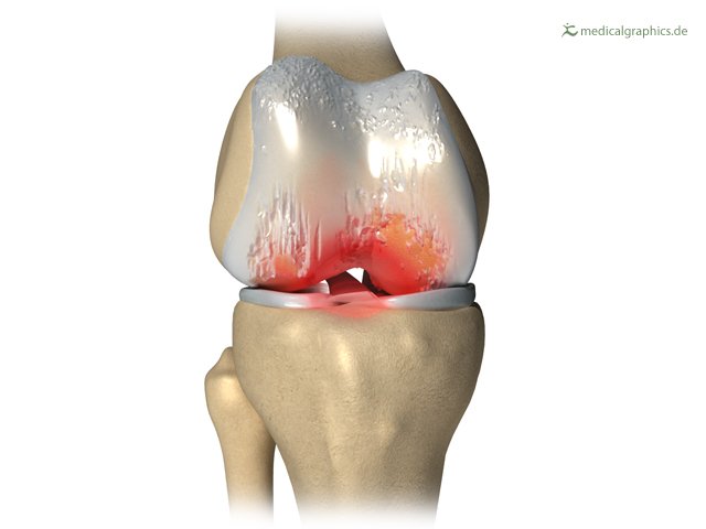 7 Tips Menjaga Kesehatan Sendi agar Terhindar dari Osteoarthritis