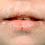5 Tips Menghindari Bibir Kering Saat Cuaca Panas