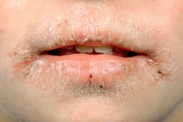 5 Tips Menghindari Bibir Kering Saat Cuaca Panas 5 Tips Menghindari Bibir Kering Saat Cuaca Panas