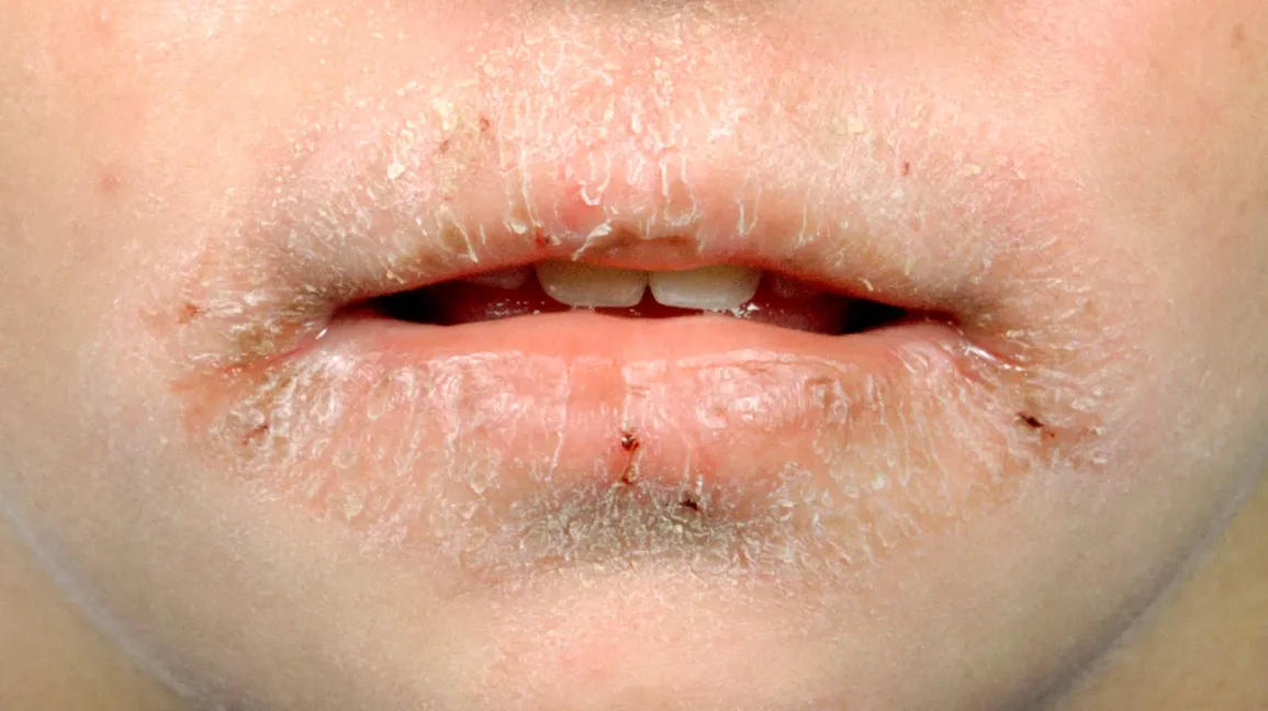 5 Tips Menghindari Bibir Kering Saat Cuaca Panas