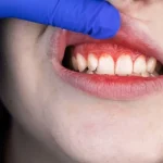 5 Tanda Gusi Tidak Sehat yang Harus Diwaspadai
