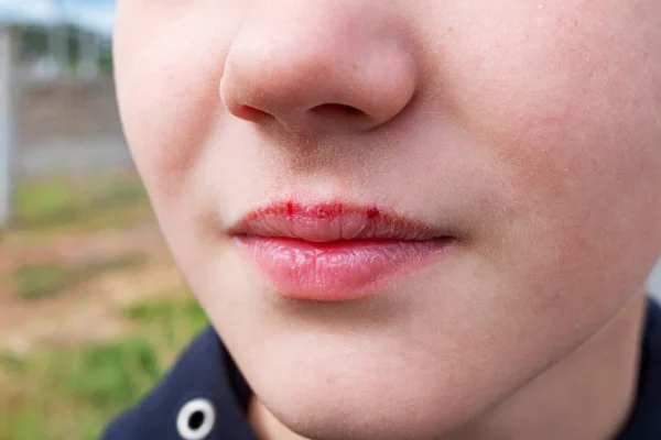 7 Tips Mencegah Bibir Kering Saat Cuaca Ekstrem
