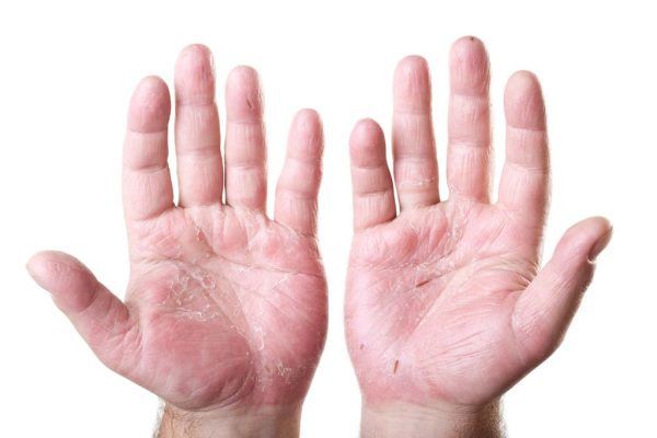 7 Tips Menghindari Kulit Kering di Telapak Tangan