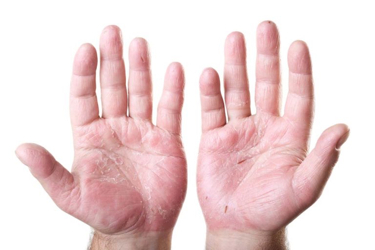 7 Tips Menghindari Kulit Kering di Telapak Tangan