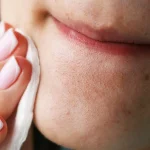7 Tips Mencegah Munculnya Komedo di Area Dagu