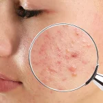 7 Kebiasaan Sehari-hari yang Bisa Memicu Jerawat