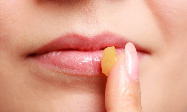 10 Tips Alami untuk Mengatasi Bibir Kering dan Pecah-pecah